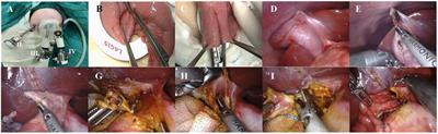 A trans-umbilical single-site plus one robotic-assisted surgery for choledochal cyst resection in children